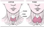 小兒甲狀腺癌