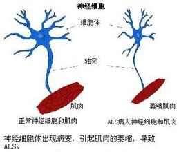 肌萎縮側索硬化癥