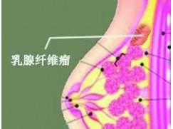 乳房纖維瘤
