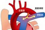 小兒動脈導管未閉