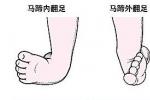 先天性馬蹄內翻足