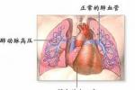 急性左心功能衰竭