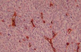 惡性血管內皮細胞瘤