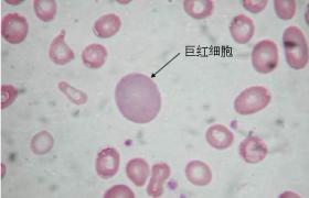 巨幼細胞性貧血