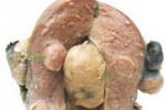 平滑肌肉瘤