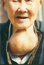 甲狀腺腫