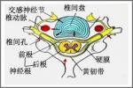 脊髓壓迫癥