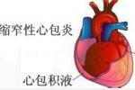 縮窄性心包炎