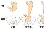 胃下垂