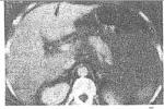 輪狀病毒性腸炎