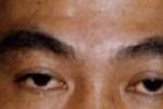 微小度數斜視