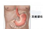 慢性淺表性胃炎