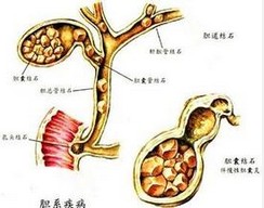 膽囊平滑肌肉瘤