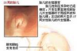 小兒腎母細胞瘤
