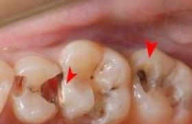 不可復性牙髓炎