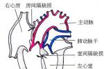 心內膜墊缺損