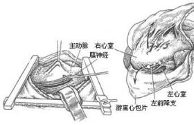 小兒結核性心包炎