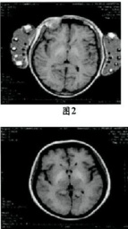 肝性腦病