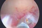 子宮內膜息肉