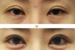 上瞼下垂