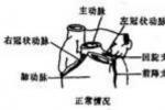 冠狀動脈異位起源