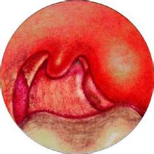 扁桃體周膿腫