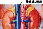 高血壓腎病