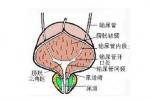 膀胱頸攣縮
