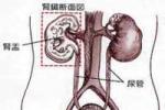 妊娠合並急性腎盂