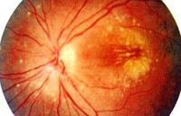 視網膜靜脈周圍炎