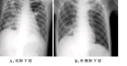 高位截癱