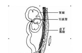 膀胱外翻