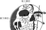 三叉神經痛