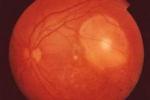 缺血性視網膜疾病