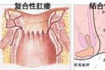 肛門失禁