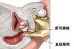肛門失禁