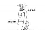 腎動脈瘤 腎動脈瘤