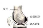 風濕性關節炎