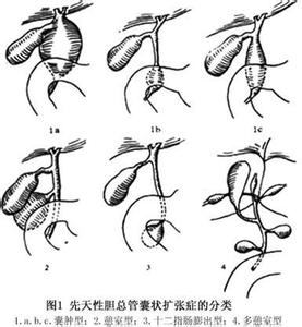 膽總管囊腫