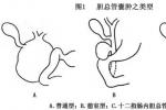 膽總管囊腫