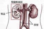 尿路感染