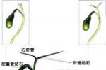 妊娠合並急性膽囊炎