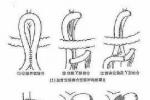 妊娠合並急性膽囊炎
