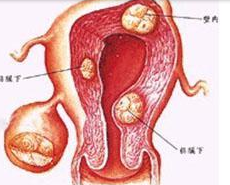 陰道惡性腫瘤