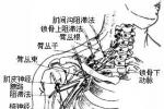 臂叢神經痛