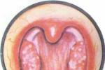 小兒腺樣體肥大