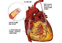 不穩定性心絞痛