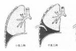 創傷性血胸