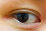 過敏性眼瞼皮膚炎