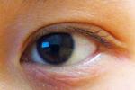 過敏性眼瞼皮膚炎